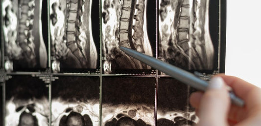 radiographie rétrécissement foraminal