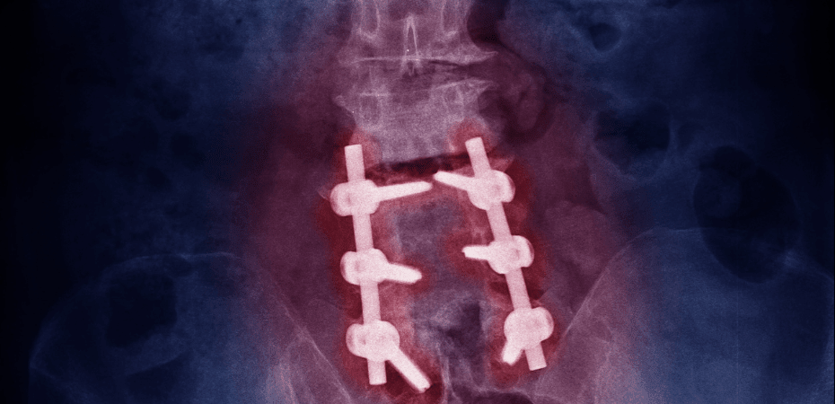 Comment bien vivre avec une arthrodèse lombaire ? - Cellsius | L’Orthopédie au service de votre bien-être