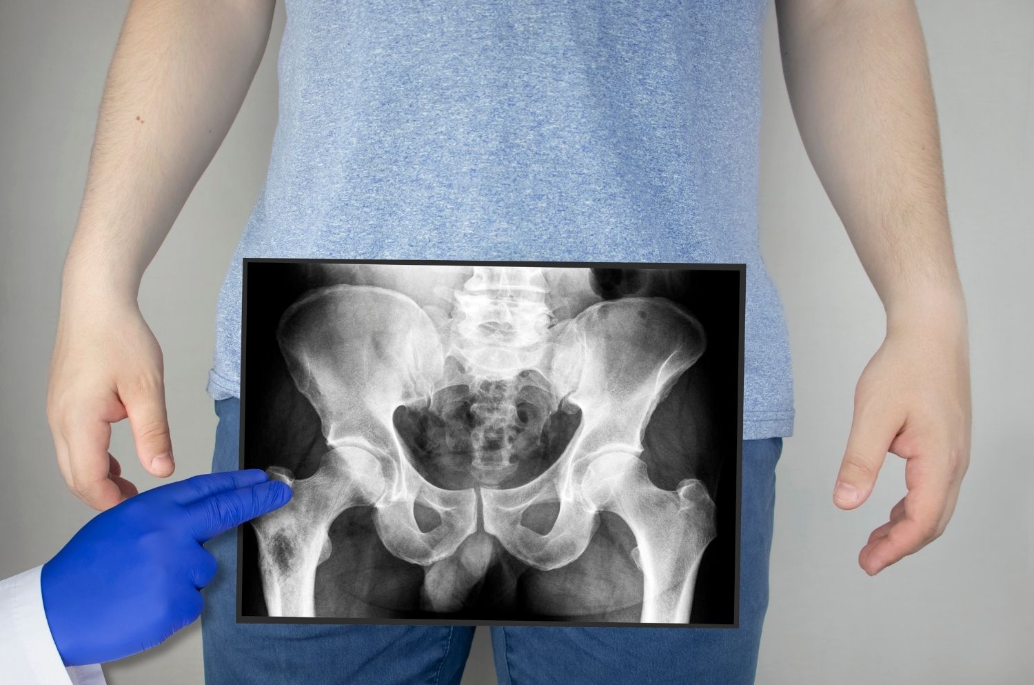 Comment corriger une bascule du bassin sans semelle ni chirurgie ? - Cellsius | L’Orthopédie au service de votre bien-être Image