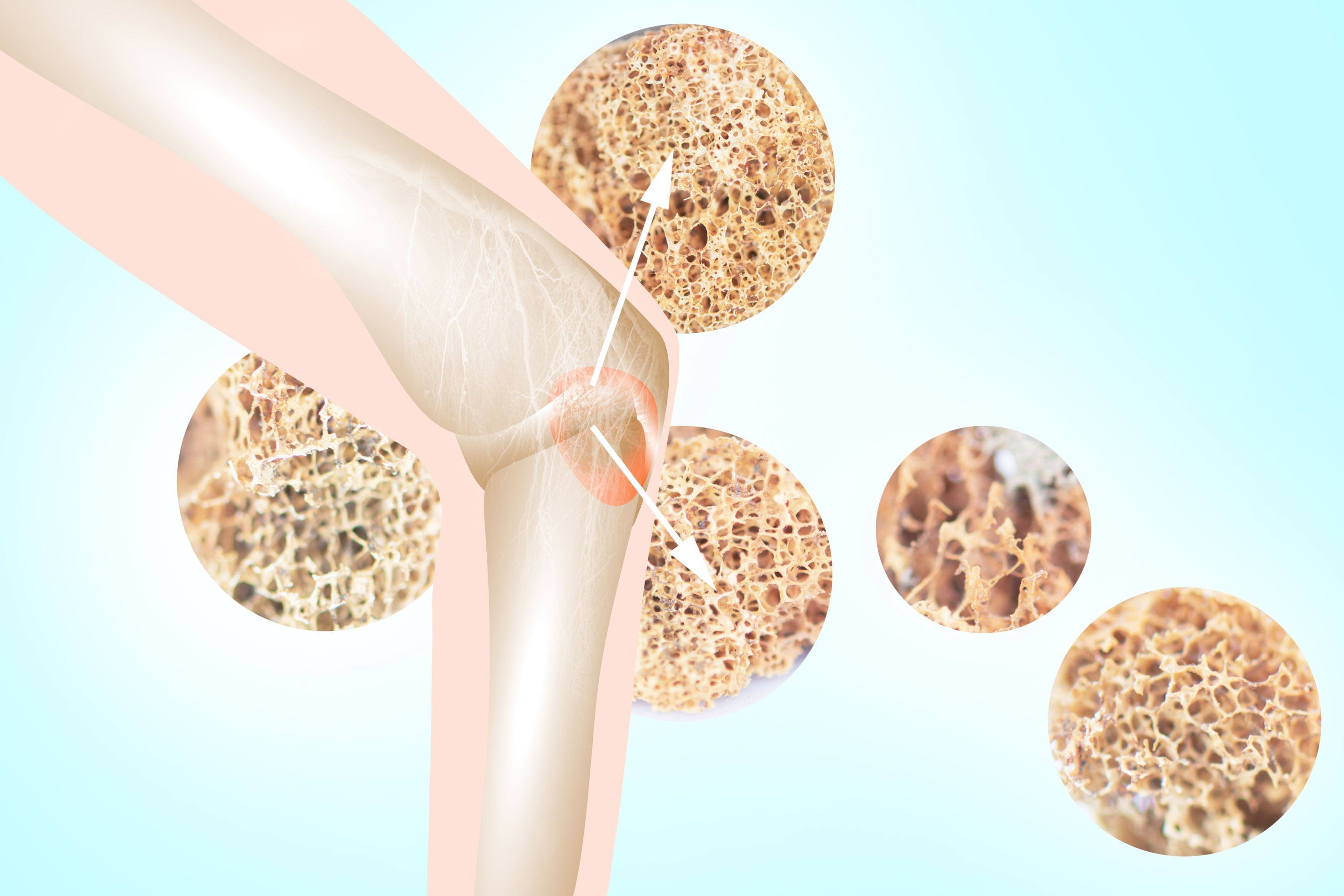 Douleur ostéoporose : 5 traitements infaillibles pour vos genoux - Cellsius | L’Orthopédie au service de votre bien-être