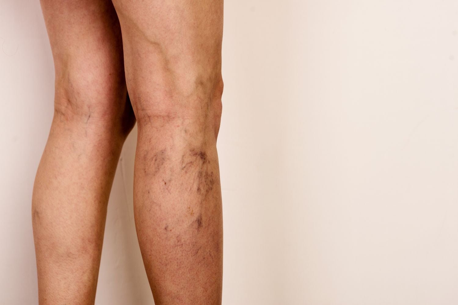 Opération des varices : bonne ou mauvaise idée ? - Cellsius | L’Orthopédie au service de votre bien-être